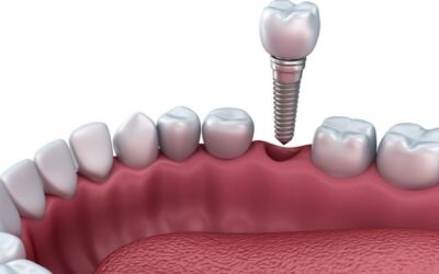 Proses Implant Gigi: Dari Pembedahan hingga Senyum Baru