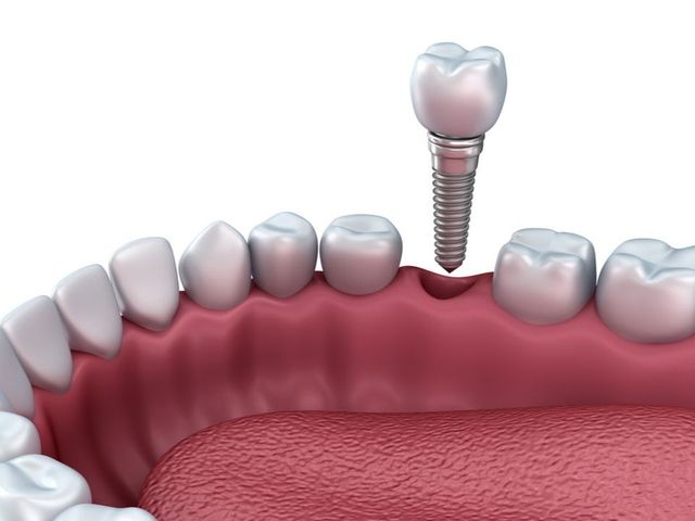 Proses Implant Gigi: Dari Pembedahan hingga Senyum Baru