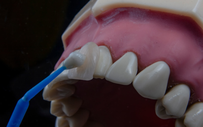 Veneer Gigi