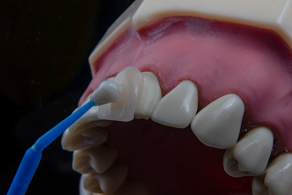 Veneer Gigi